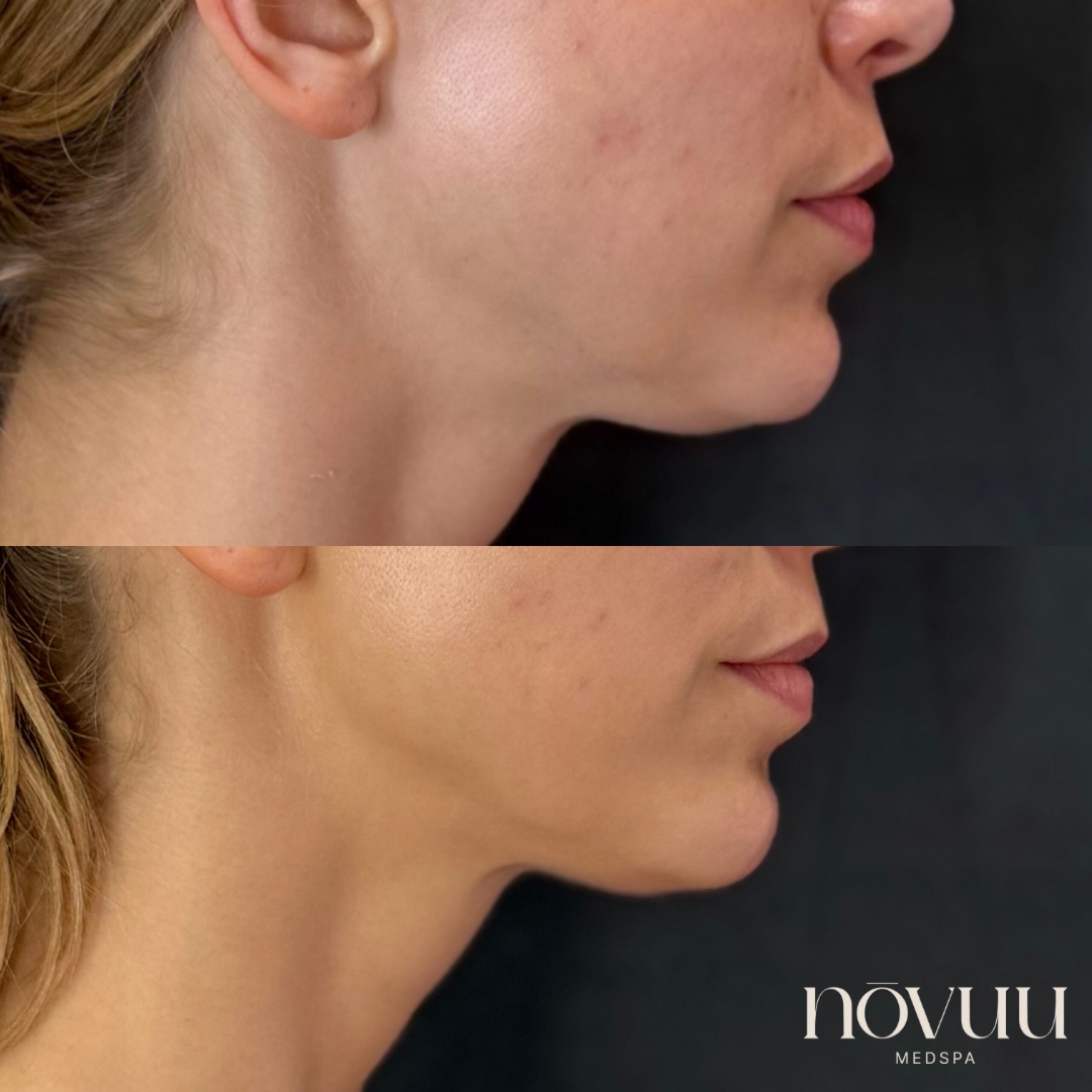 Nefertiti Neck Lift