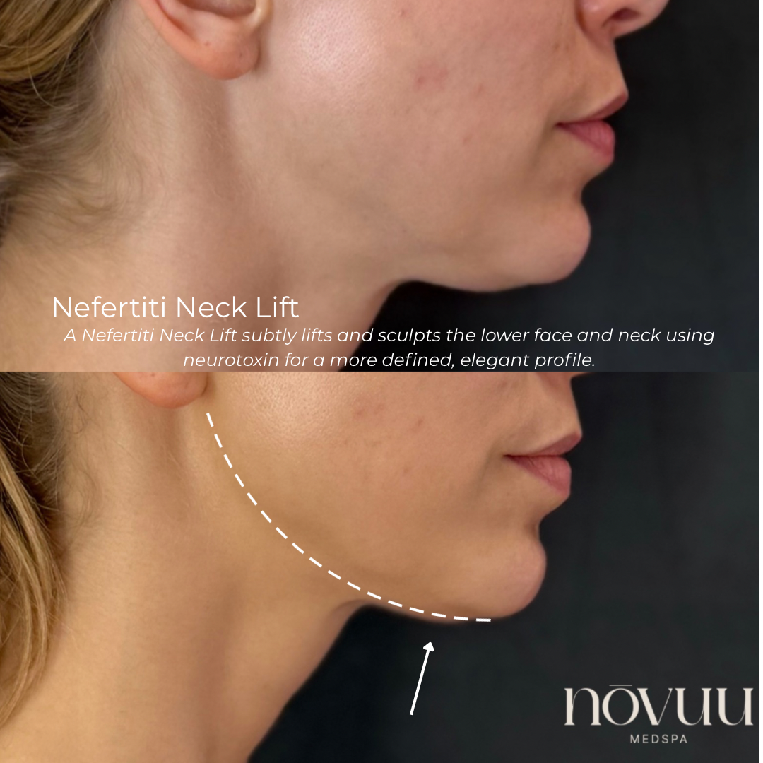 Nefertiti Neck Lift