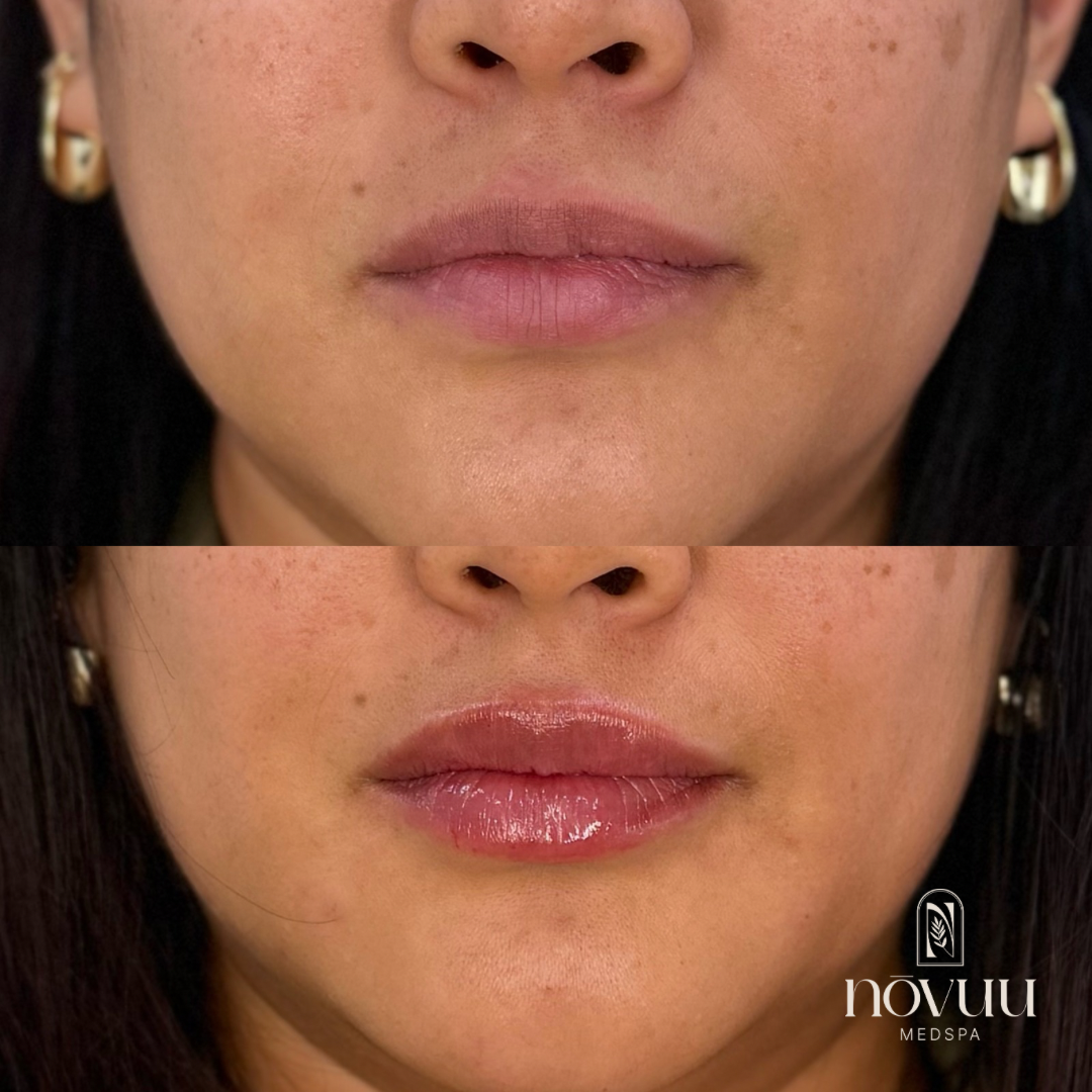 Melasma 4