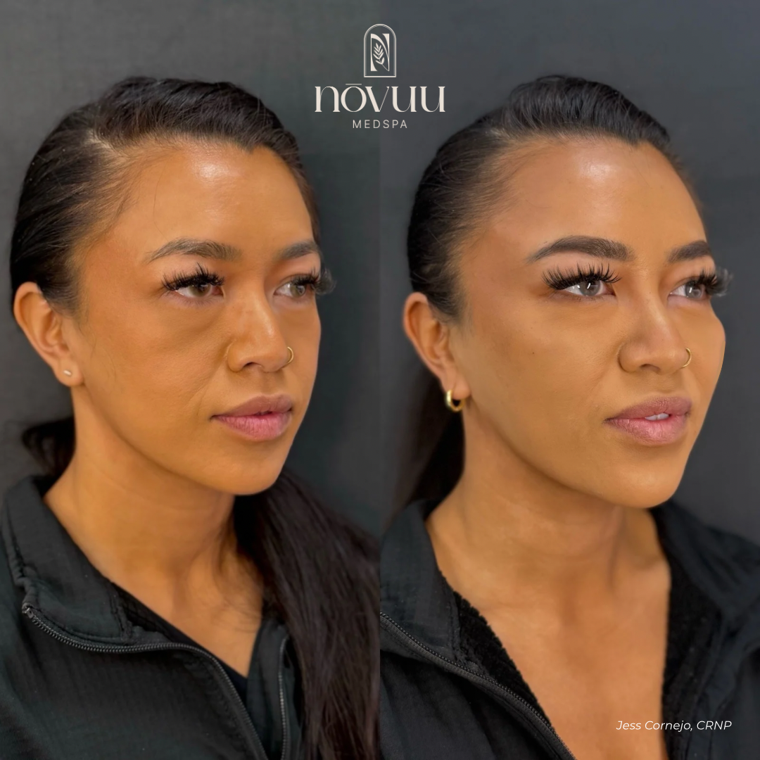 Melasma - 4