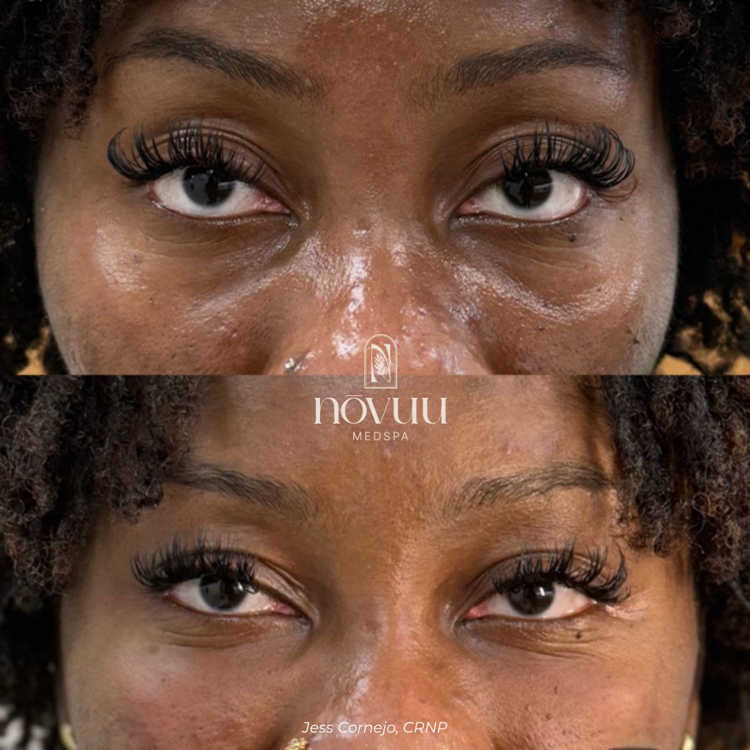 Melasma - 7