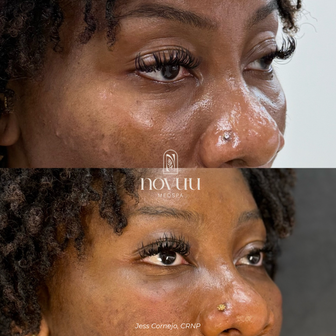 Melasma - 8