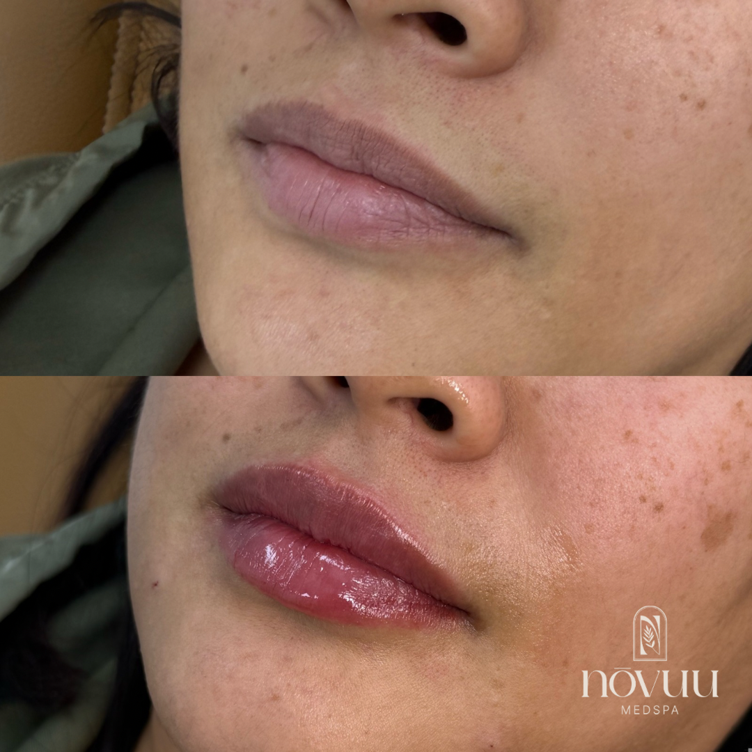 Melasma